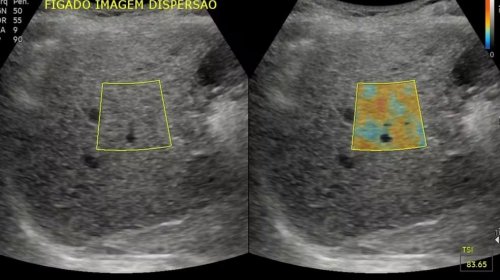 [Clínica oferece exames gratuitos para pacientes diagnosticados com gordura no fígado em Salvad...]