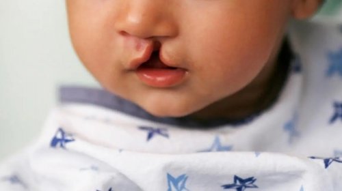 [Cirurgias para correção de lábio leporino aumentam mais de 40% em Salvador nos últimos três an...]